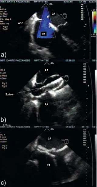 Fig. 2 - TEE during percutaneous occlusion of an ASD with a Helex  septal occluder a) fossa ovalis type ASD, located in the central part  of the septum, with the fl ow directed from the left atrium to the  right; b) Balloon interposition through the defect