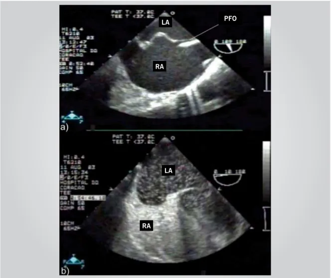 Fig. 3 - TEE demonstrating a) patent foramen ovale (PFO), associated to an aneurysm of the interatrial septum; b) contrast study, delineating the aneurysm  and showing a large amount of microbubbles crossing from the right atrium to left atrium