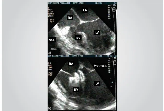Fig. 6 - a) Bidimensional TEE of an ostium secundum ASD; b) live 3-D reconstruction of the same defect that presents an aberrant shape