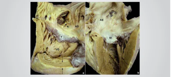 Fig. 4 - Macroscopia do coração aberto mostrando as câmaras direitas (a) e esquerdas (b)
