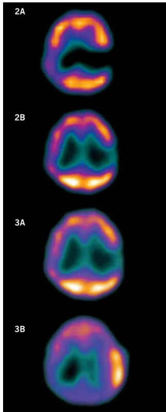 Fig. 2A – Single-photon emission computed tomography performed  before bone marrow mononuclear cell infusion, showing hypoperfusion  in the left temporal region