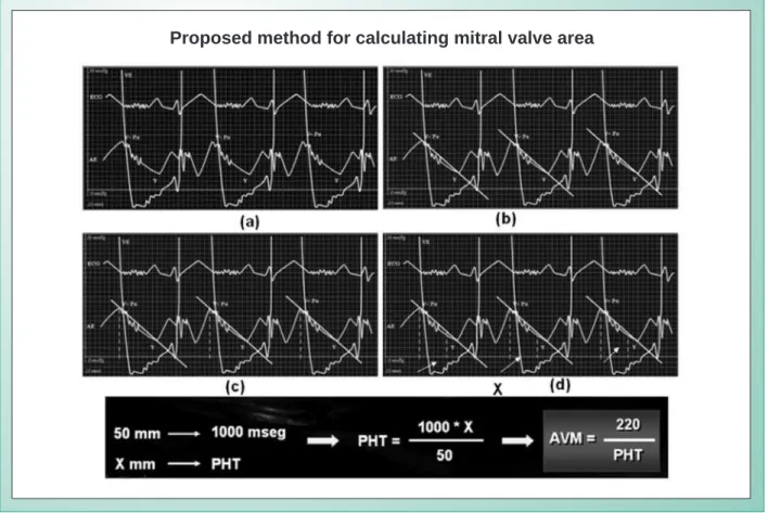 Fig. 1 - Proposed methodology. On (a) simultaneous pressure recording VE-AE. In (b) - line projected onto the LA pressure curve accompanying the rapid filling phase,  between points v and y