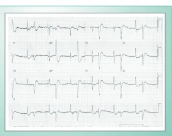 Fig. 1 - ECG. Ritmo de fibrilação atrial com alto grau de bloqueio  atrioventricular e extra-sístoles ventriculares; sinais indiretos de sobrecarga  atrial direita.