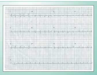 Fig. 2 - ECG. Ritmo fibrilação atrial, desvio do eixo QRS para direita, baixa  voltagem dos complexos QRS.