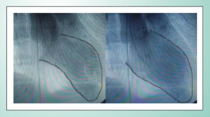 Fig. 3 - Pseudoaneurysm in middle third of the anterior descending artery.