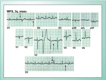 Fig. 1 - Eletrocardiograma de criança de três anos, em surto reumático  agudo inicial