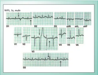 Fig. 1 - Electrocardiogram of a three-year-old boy in an initial rheumatic  fever crisis