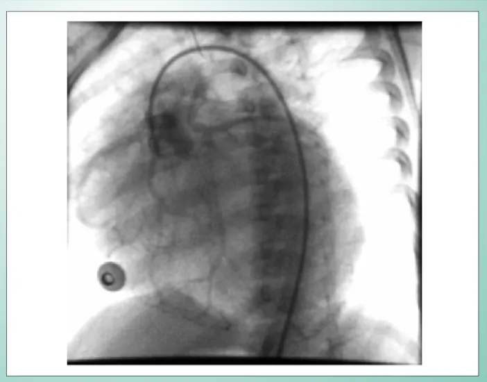 Fig. 1 - Aortography in the left anterior oblique (LAO) projection: the right coronary artery arises from the right coronary sinus, with retrograde opacification of  the left coronary artery up to the pulmonary trunk