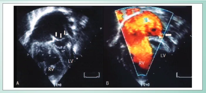 Fig. 1 - A) Imagem do septo atrial desviado para a esquerda simulando cor triatriatum (setas)