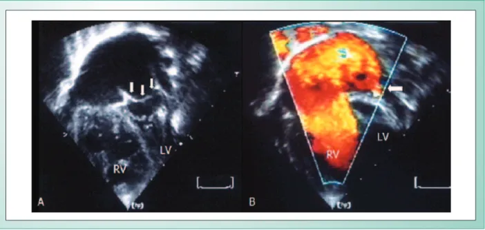 Fig. 1 - A) Image of the atrial septum deviated to the left, mimicking cor triatriatum (arrows)