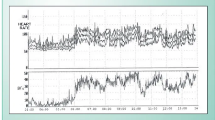 Fig. 1 - Example of RVOT PB.  Fig. 2 - 24-hour Holter showing PB frequency.