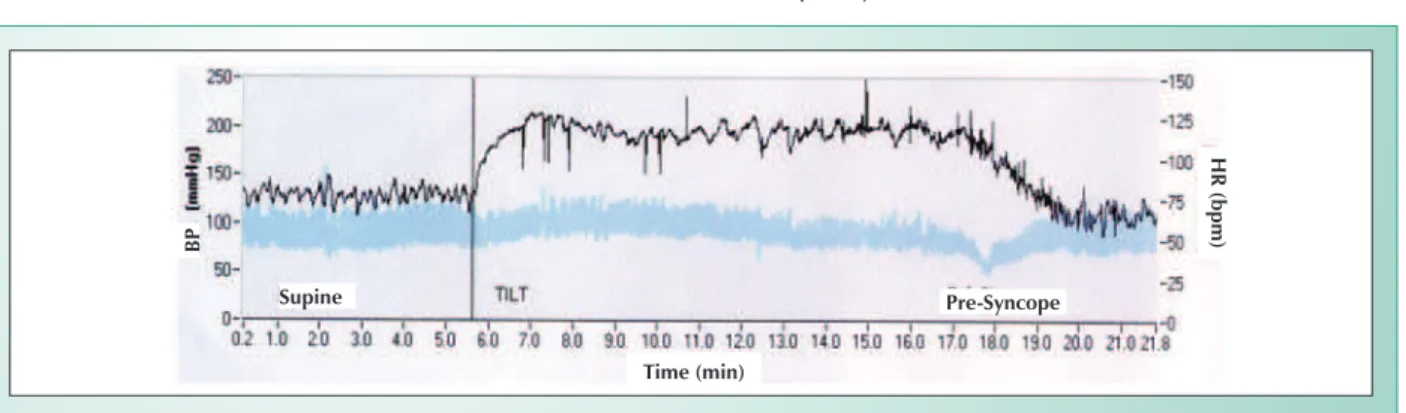 Fig. 3 - Positive Tilt Table Test in patient with RVOT  PB. BP- blood pressure; HR- heart rate.