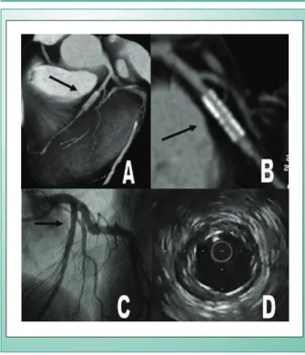 Fig. 6 - Comparison of three-dimensional CT reconstructions (A), longitudinal  reformatting (B) and invasive angiography (C) of  a sirolimus-eluting stent in the  left anterior descending artery (case 21).