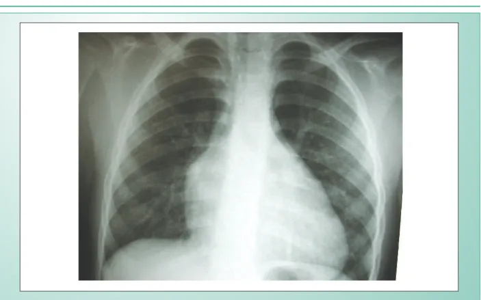 Fig. 1 - Chest radiograph shows the presence of a bulging middle arch corresponding to the rudimentary right chamber located to the left, with a long ventricular border  originating in the single left ventricle to the right