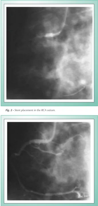 Fig. 1 - Stenotic lesion in the RCA ostium.