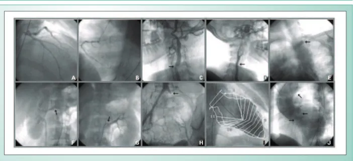 Fig. 2 - Preinterventional angiography: A and B: left and right coronary arteries, respectively, with no obstructive lesions; C: left common carotid artery with severe  obstruction; D: right common carotid artery with mild obstruction; E: left subclavian a