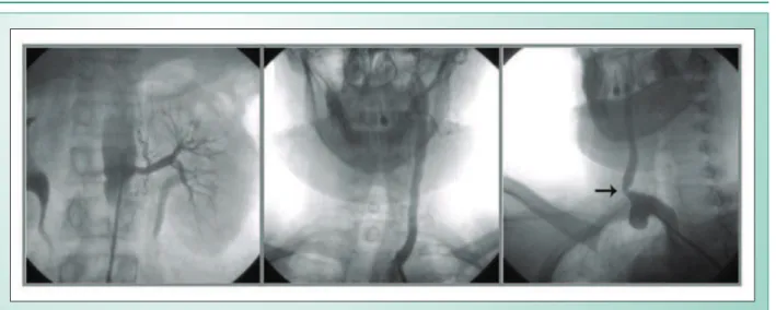 Fig. 5 - Successful previous interventions remained unchanged. Lesion in the right common carotid artery.