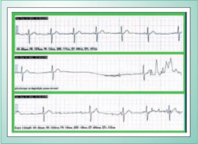 Fig. 1 - Loop event recording.