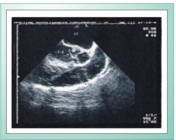 Fig. 4 - Post-operative bidimensional echocardiogram with slight aortic  valve reflux.
