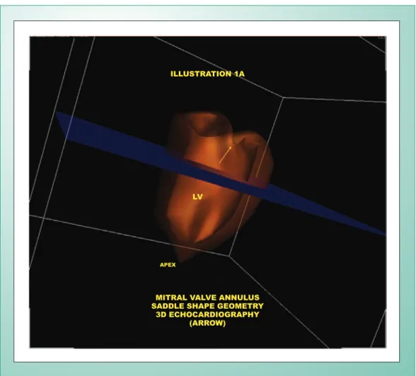 Fig. 1A - Three-dimensional transthoracic echocardiogram (3D)  (longitudinal, apical projection), showing saddle shape of mitral valve  annulus (arrow)