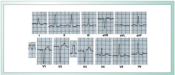 Fig. 1 - Left ventricular and atrial overload and left bundle branch block. Observe biphasic T waves in D1 and V6, with straightening of the ST segment in the inferior  wall