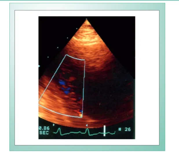 Fig. 2 - Doppler echocardiogram demonstrating myocardial trabeculations in the septal-apical region of the left ventricle.