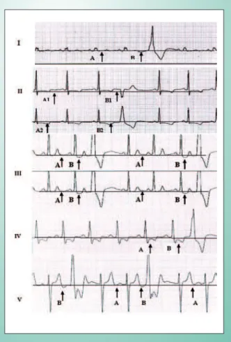 Fig. 1 - Electrocardiographic Changes Preceding Ventricular Premature  Beats.