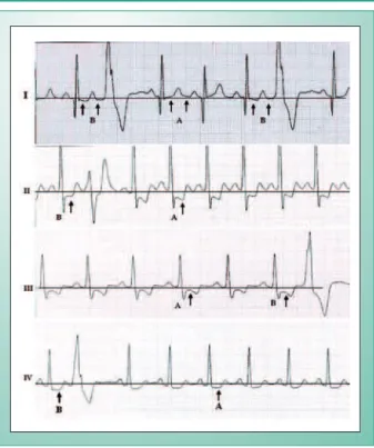 Fig. 3 - Electrocardiographic Abnormalities Preceding Ventricular Premature  Beats.