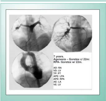 Fig. 3 - Post operative angiography of the 22 month old case when the  patient was 7 years old, demonstrates the continuity of the reconstructed  pulmonary tree