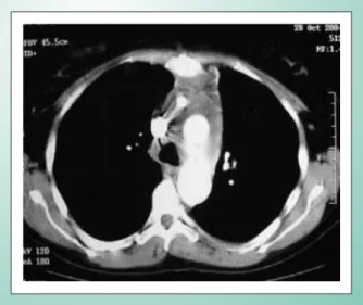 Fig. 2 - Preoperative CT depicting the type-1 dissection. B) Postoperative CT 