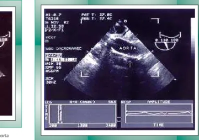 Fig. 1 - Ecocardiograma transesofágico demonstrando aneurisma de aorta  ascendente (7,3 cm)