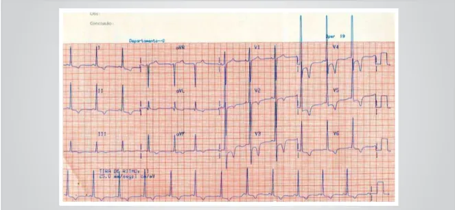 Fig. 1 – Eletrocardiograma. Ritmo de fibrilação atrial e intensa sobrecarga ventricular esquerda, com alterações secundárias da repolarização  ventricular.