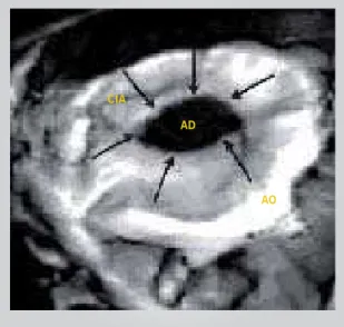 Fig. 1 – Ecocardiograma bidimensional transesofágico multiplanar  do paciente, com comunicação interatrial tipo ostium secundum;