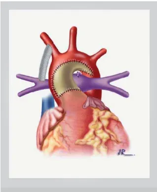 Fig. 1 – Modified Norwood operation with patch arch reconstruction. The  pulmonary blood flow is supplied by a modified Blalock-Taussig shunt.