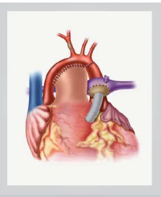 Fig. 2 – Modified Norwood operation without patch arch reconstruction. 
