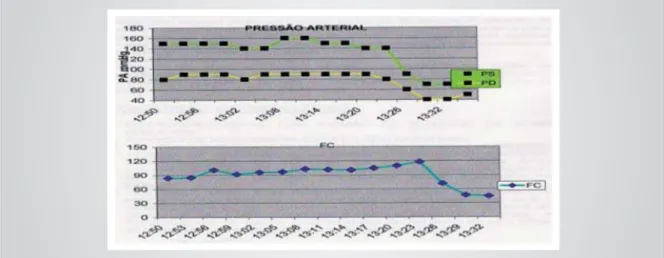 Fig. 1 – Tilt test with positive and mixed pattern response. Heart rate increase before the test is positive may suggest benefit with the use of betablockers