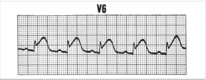 Fig. 3 - The hyperacute phase of the myocardium infarction.
