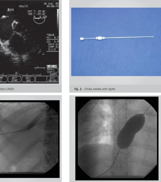 Fig. 3 – Confi rmation of hepatic vein puncture. Fig. 4 – Balloon positioned for measuring ASD distended diameter.