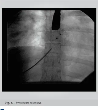 Fig. 5 – Prosthesis released.