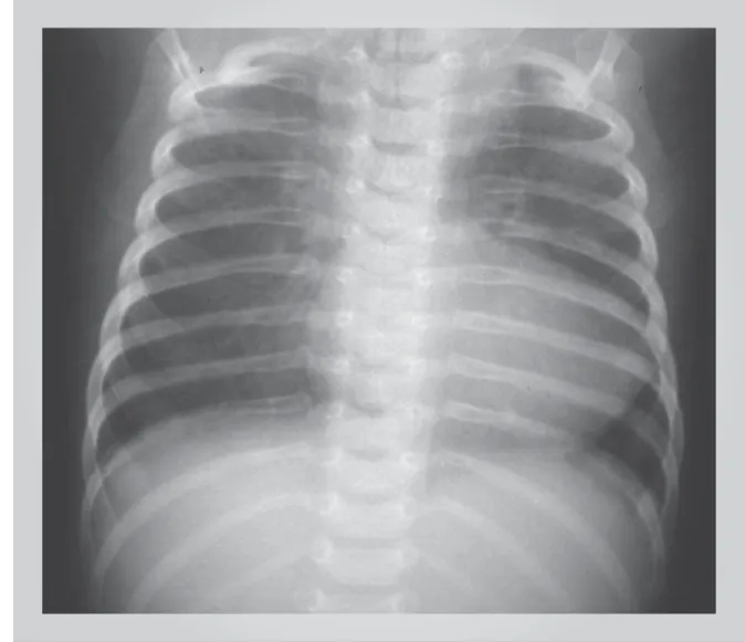Fig. 1 - Chest radiograph shows signs of obstructive heart disease in the left side of the heart with the presence of a prominent pulmonary vasculature  due to venous congestion and enlarged left atrium, in addition to a round-shaped heart due to right myo