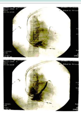 Fig. 1 - At the bottom: leads in RV and RA, and coronary sinus venogram. On  top: lead in coronary sinus positioned in left lateral vein