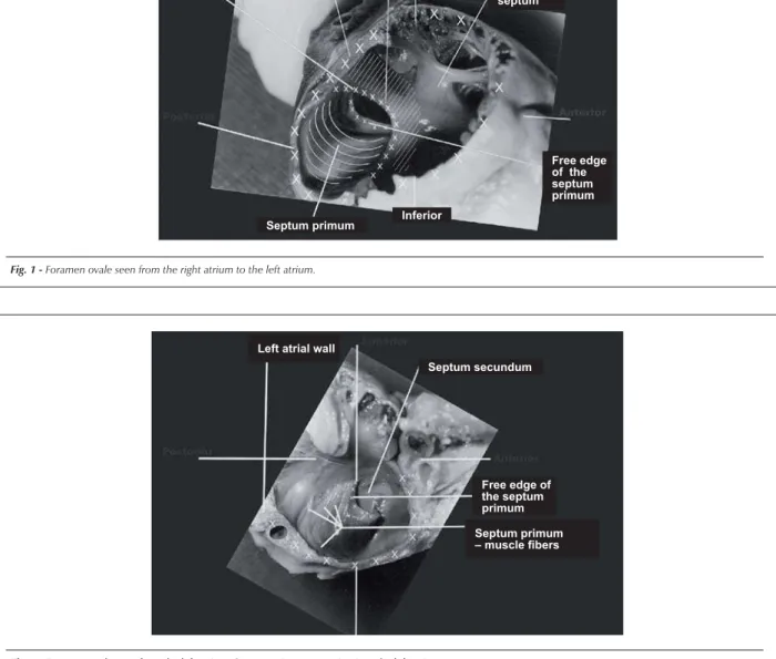 Fig. 2 - Foramen ovale seen from the left atrium. Septum primum excursion into the left atrium