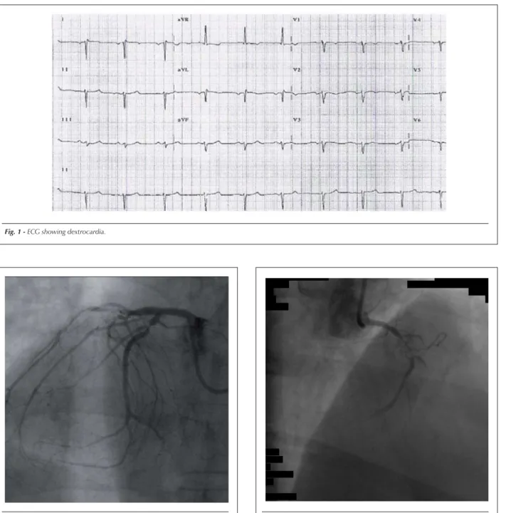 Fig. 2 - Coronary angiography of the left coronary artery. 