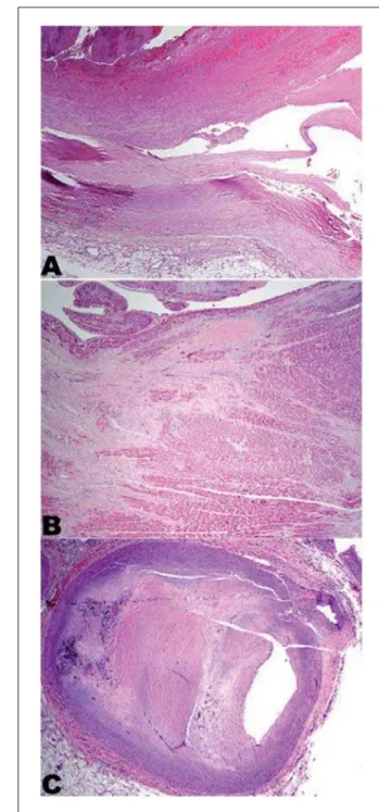 Fig. 3 - A - Low power view of the saphenous vein graft aneurysm to the  right coronary artery showing dissection plane (right to left) with disruption  of the intima and of the media, fibrin thrombus formation and hemorrhage  (original magnification, 20x)