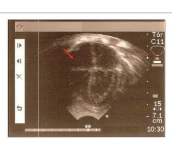 Fig. 3 - Apical four-chamber view  showing total thrombus dissolution (arrow)  after three months of therapy.