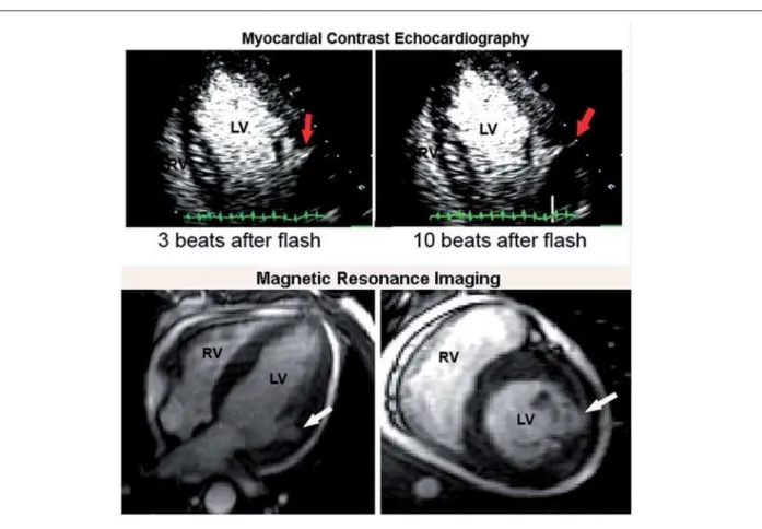 Fig. 2 - Contrast Echocardiography (upper panel) showing left ventricular opacification with contrast extrusion from the left ventricular cavity into the myocardium in the  lateral wall, before reaching the pericardial space, suggesting an impending ruptur
