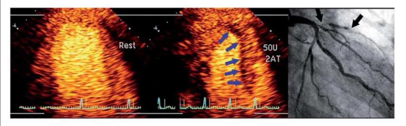 Fig. 4 - Dobutamine stress real-time myocardial contrast perfusion echocardiography showing normal myocardial perfusion at rest (image on left) and subendocardium  perfusion defect in the anterior septum at peak dobutamine stress (middle image)