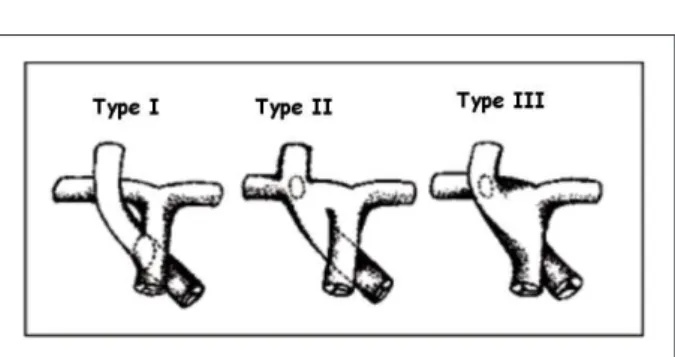 Fig. 1 - Anatomical types of aortopulmonary window – Type I – proximal; Type  II – distal defect; Type III – complete defect (adapted from Soares AM et al).