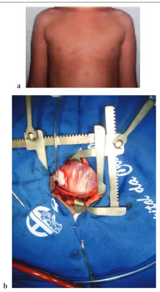 Fig.  2  - a,  Anterior  Minithoracotomy  with  Partial  Median  Sternotomy;  b,  Placement of the Finochietto Retractors.