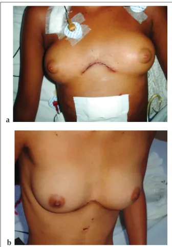 Fig. 3 - a and b, Anterior Minithoracotomy with Partial Median Sternotomy.